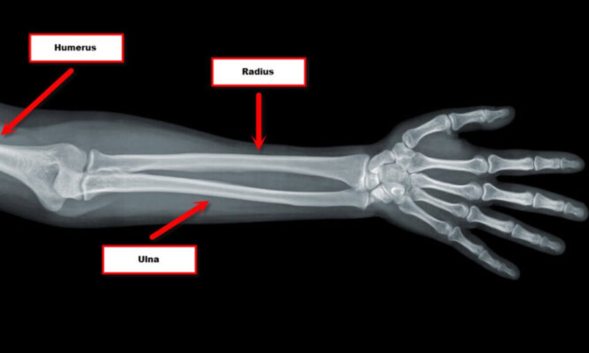 ARM Bones Understanding The Anatomy And Functionality JOI Jacksonville Orthopaedic Institute ARM Bones Understanding The Anatomy And Functionality JOI Jacksonville Orthopaedic Institute